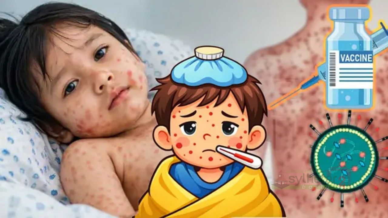 সিলেটে ২৪ ঘন্টায় হামে প্রাণ গেল আরও এক শিশুর 